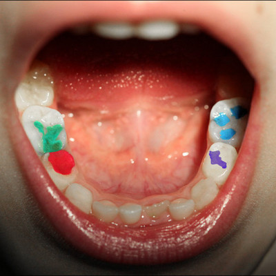 Кольорові пломби в стоматології